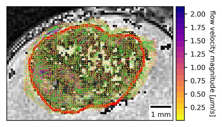 MRI with contrast shows heterogenous interstitial fluid flow in glioblastoma. The tumor border is outlined in red. Credit: Kingsmore et al.