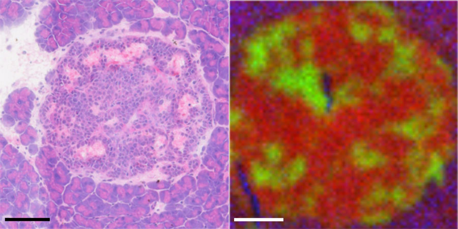 Islet tumor region shown with normal staining and with the time-of-flight secondary ion mass spectrometry. Fatty molecules appear in red, iron and other blood-related components are green, and surrounding tissue is blue. Credit: Dan Graham and Blake Bluestein