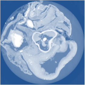 X-ray Tomography with Grating Interferometry