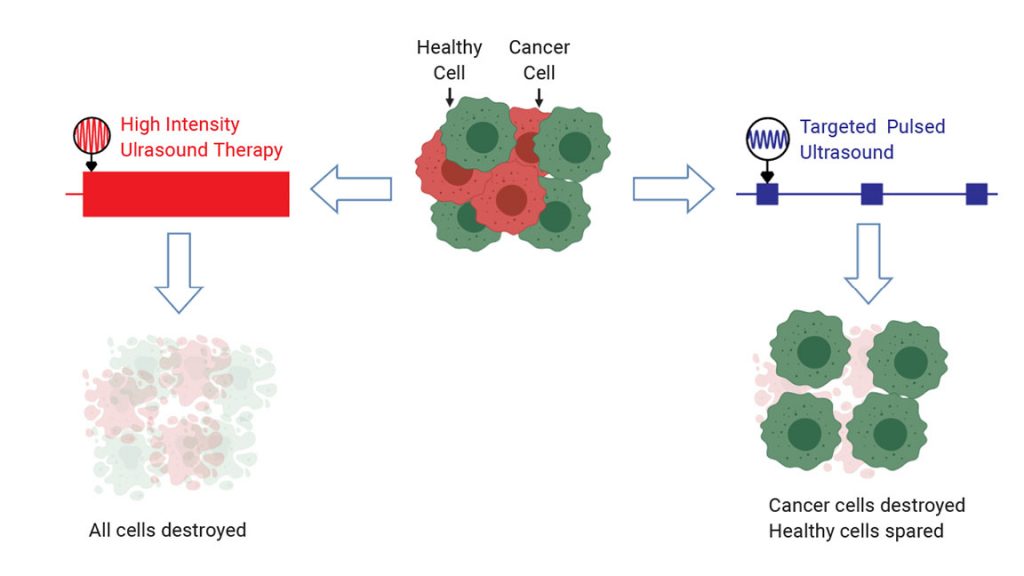 Targeted pulsed ultrasound takes advantage of the unique mechanical properties of cancer cells to destroy them while sparing healthy cells. Credit: David Mittelstein