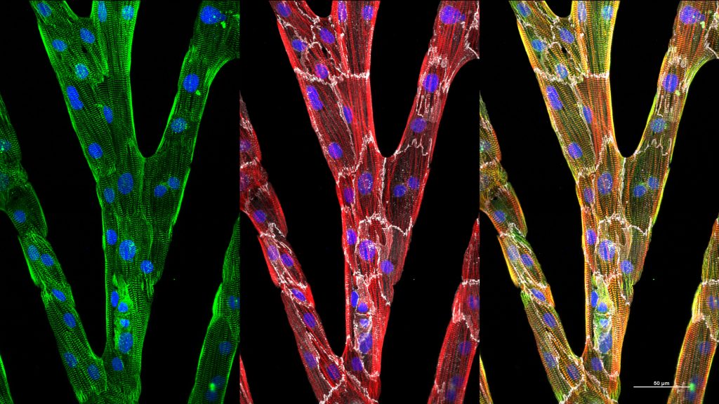 The three images show individual heart cells (outlined in white) that have elongated and aligned their internal cytoskeletal structure when grown in micropatterned lanes. The addition of bridges between lanes results in synchronized contraction over a large 2D area. CREDIT: Brett N. Napiwocki