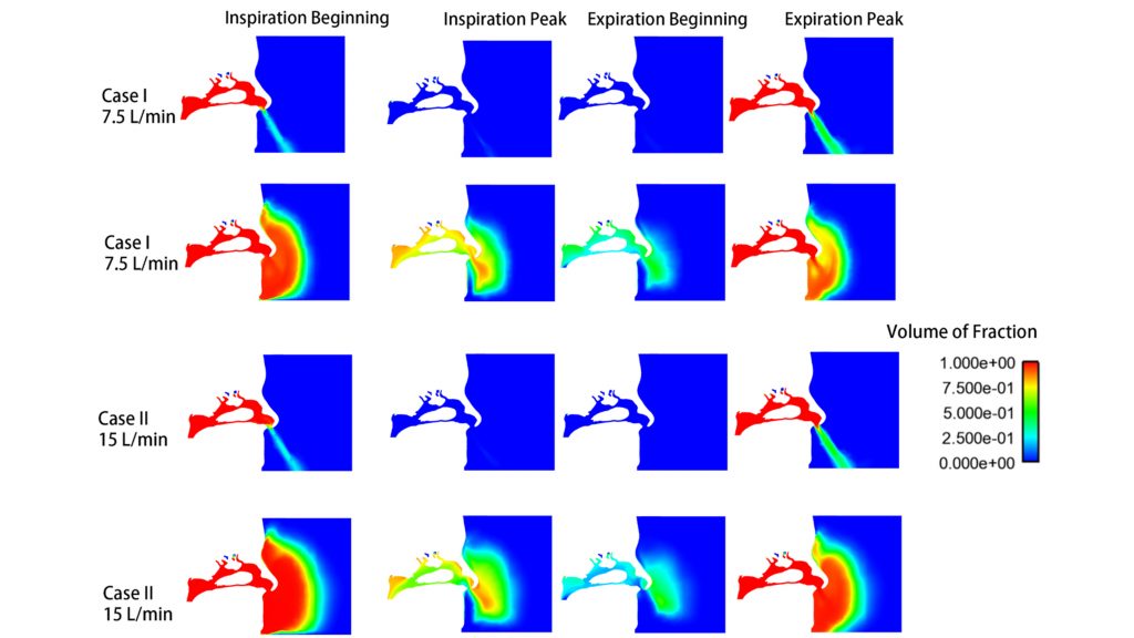 Volume of fraction of respired air at beginning/peak of inspiration and expiration under the ventilation rates of both 7.5 liters per minute (cases I) and 15 liters per minute (cases II). The color in blue represents the volume occupied by pure fresh air, while the red color represents the volume occupied by pure respired air. The colors in between represent a mixture of fresh and respired air. CREDIT: Heow Pueh Lee