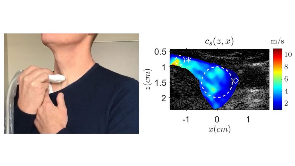 Left: Using the technique to prove the shear wave speed in a volunteer’s thyroid. Right: The speed of shear waves in the thyroid measured with V-PE. CREDIT: Steve Beuve
