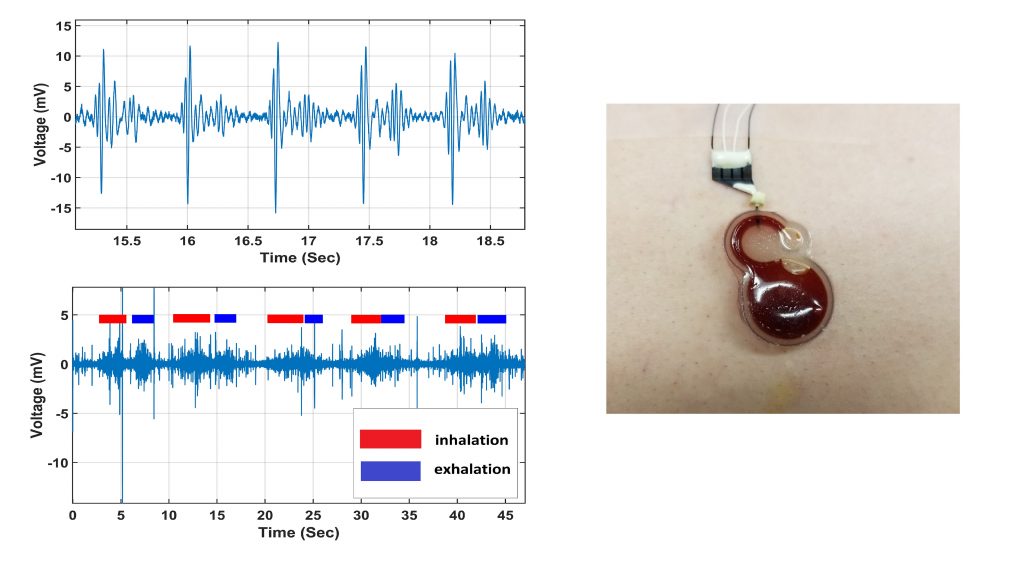 Right: Wearable sensor attached to a patient’s chest. Left top: Heartbeat signal acquired from the sensor. Left bottom: Acquired breathing signal. CREDIT: Yong Xu