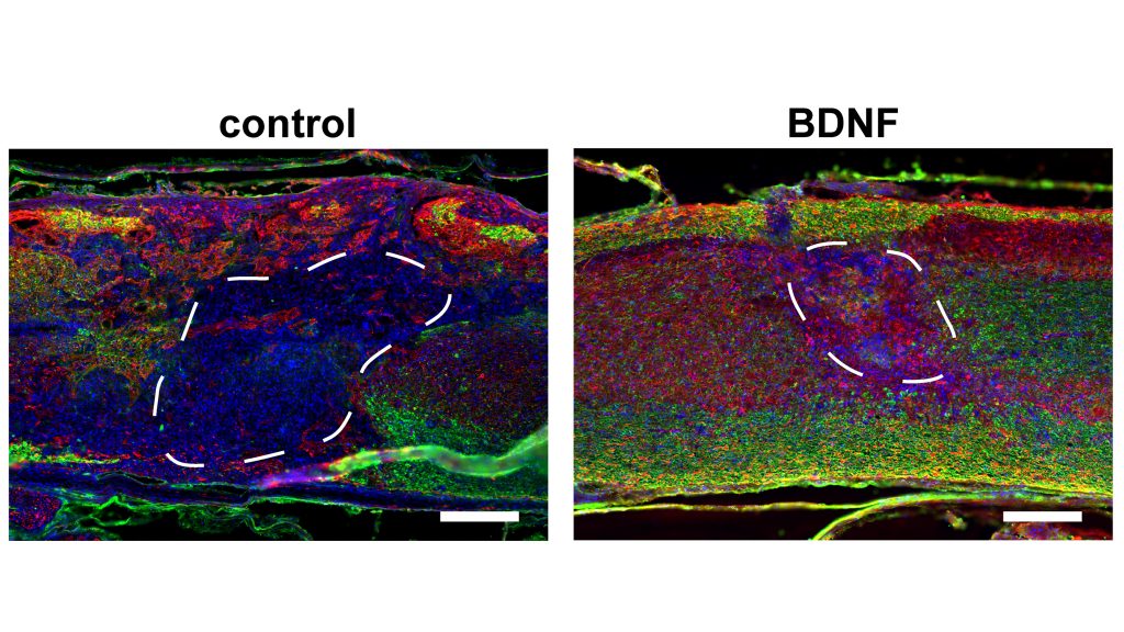 Images show myelinated axons in biomaterial scaffolds eight weeks after injection into the injured cord of a mouse. Scaffolds were fabricated from hyaluronic acid (HA) with a regular network of cell-scale macropores and loaded with gene therapy vectors encoding for brain-derived neurotrophic factor (BDNF), to promote axonal survival and regeneration. These were compared to control scaffolds, which were lacking the BDNF vector. Images show dense infiltration of cells (shown in blue, cell nuclei), axons (shown in red in A, NF200 protein) and myelinating glial cells (shown in green, myelin basic protein) in the BDNF-laden scaffolds. Scale bars = 200 µm. CREDIT: Seidlits et al.