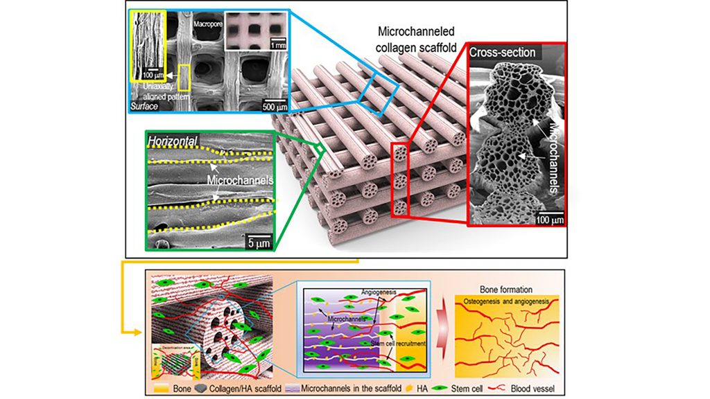 Surface, cross-sectional optical/SEM images showing the uniaxially aligned surface patterns and microchannels within the struts of the fabricated collagen scaffolds. A schematic showing the osteogenesis and angiogenesis of the fabrication of mineralized, microchanneled collagen scaffold. CREDIT: Hanjun Hwangbo, Hyeongjin Lee