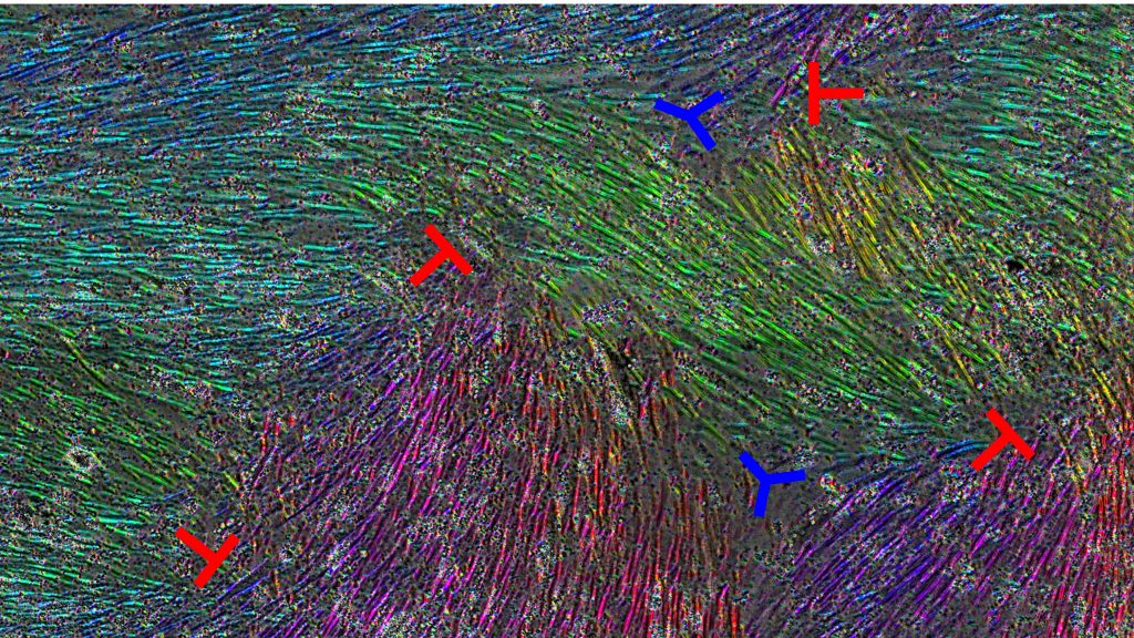 Mesothelial cells with colors indicating direction of cell orientation. Red and blue symbols denote topological defects. CREDIT: Jun (Jay) Zhang