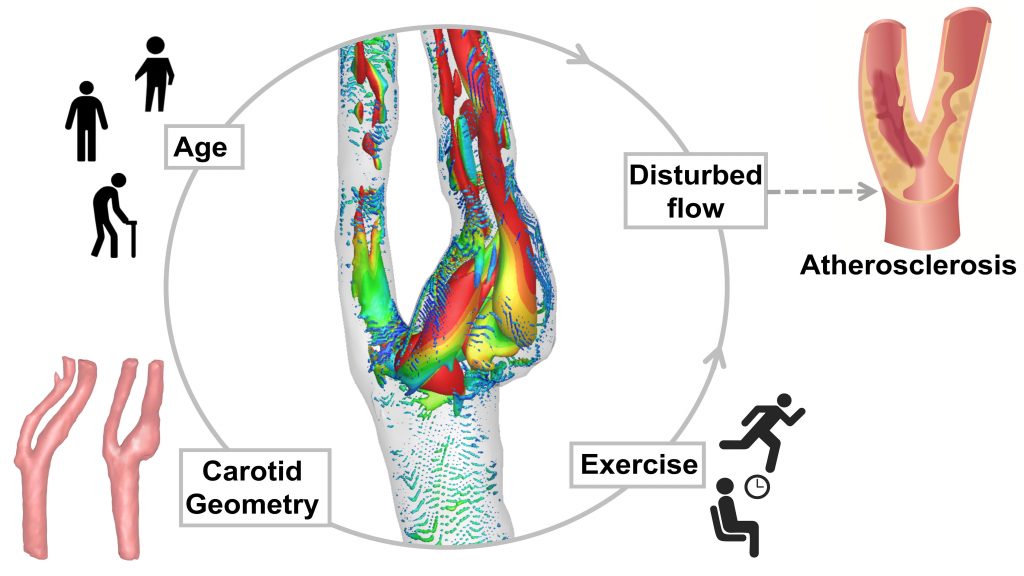 Exercise, age, and carotid geometry all have effects on disturbed flows, which are correlated with the initiation and formation of atherosclerotic plaques. CREDIT: Xinyi He, Xiaolei Yang
