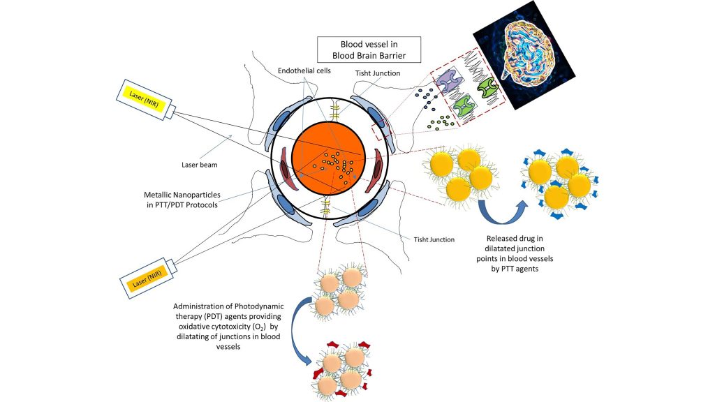 Combined PDT/PTT approaches for the treatment of brain tumors. Dual function nanoparticles are used for combined PDT/PTT approaches. In PDT, the PS to produce ROS can be attached to nanoparticles and delivered to the tumor. The combination of nanoparticles and irradiated laser beam increases the permeability of the microvessels to transfer nondiffusible drugs across the vessel wall. CREDIT: Nasseri et al.