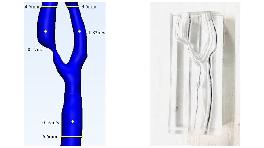 3D reconstruction of a carotid artery stenosis vessel, and diameter and flow rate at the blood vessel inlet and outlet (left) and 3D printed simulation model (right). CREDIT: Zhiyong Song, Pengrui Zhu, Lianzhi Yang, Zhaohui Liu, Hua Li, and Weiyao Zhu