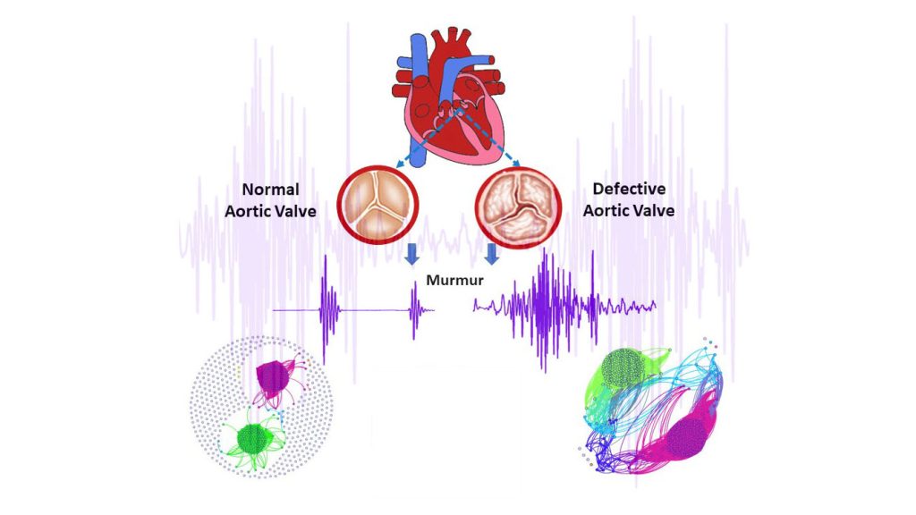 A normal aortic valve (left) versus a defective aortic valve (right) and their different sound signals (purple). The sound data was used to generate graphs at the bottom corners, which differ greatly and can help diagnose aortic valve stenosis. CREDIT: M.S. Swapna
