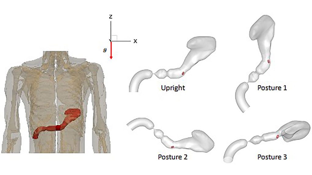 Diagram showing the original position of the stomach relative to the body and different relative positions of the stomach with respect to the direction of gravity considered in this study. CREDIT: Rajat Mittal