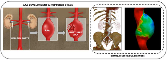 AAA development and ruptured stage (left) and simulated results (right). Credit: Cardiovascular Biomechanics Lab