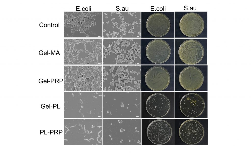 To create a new wound-care gel, researchers used a common hydrogel, Gel-MA, and created several combinations infused with platelet-rich blood plasma (PRP) and polylysine (PL). To test the gel’s ability to battle bacteria, they added E. coli and S. aureus, the bacterium that causes staph infection, and used scanning electron microscopy and plate counts to determine the best combination. Credit: Peiyu Yan