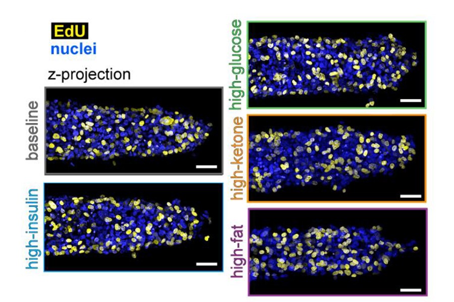 A team of researchers at Princeton, capturing in detail the metabolic effects of high-fat nutrients, found that a high-fat diet accelerates growth and invasion of breast cancer tumors. Credit: Kohram et al.